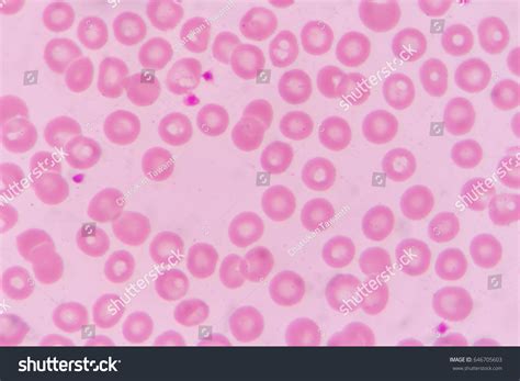 Normochromic Normocytic Red Blood Cells Stock Photo 646705603