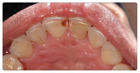 Holes In Teeth That Arent Cavities Understanding Enamel Defects