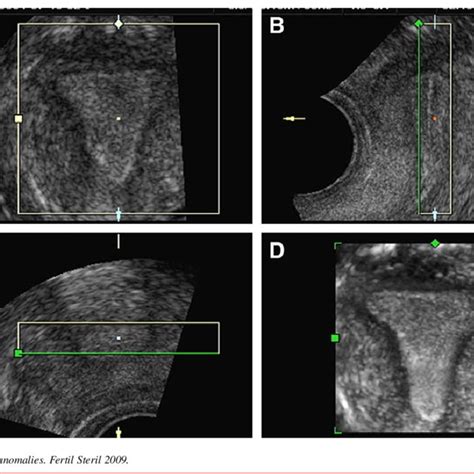Multiplanar Imaging Of A Normal Uterus At Volume Ultrasound The Volume