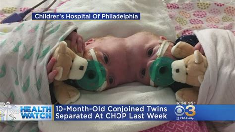 Conjoined Twins Connected At Head Successfully Separated Youtube