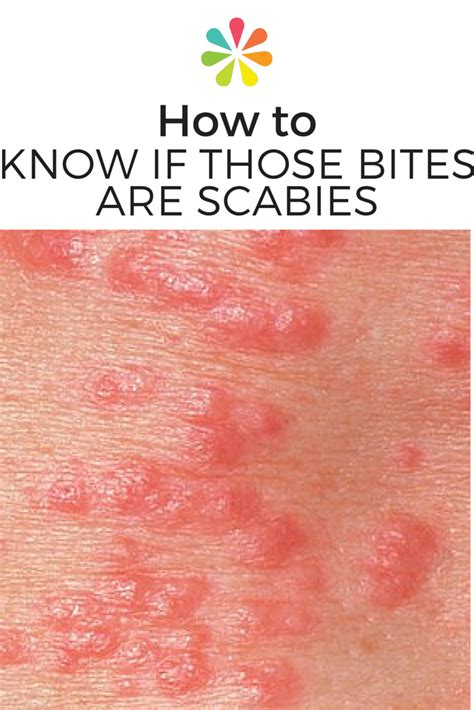 How To Know If That Rash Is Scabies Everyday Health Home Remedies
