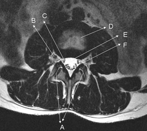 Axial MRI Lumbar Spine