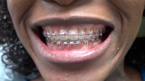 They are not braces themselves, but merely ligatures that are placed as an addition to the braces. {#94} POWER CHAIN REPLACEMENT ON MY BRACES ~ AT THE ...