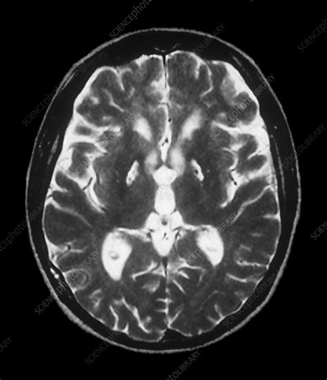 Anoxia Brain Damage Mri Scan Stock Image C0041465 Science Photo