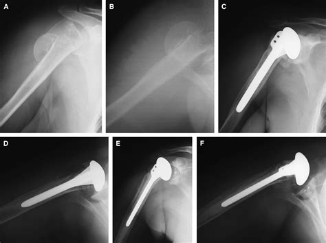 Shoulder Hemiarthroplasty For Acute Fractures Of The Proximal Humerus