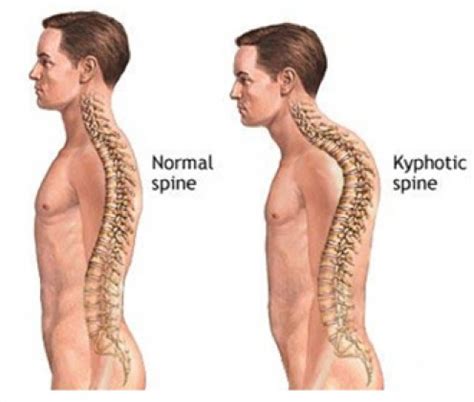 A rounded mass or protuberance, such as the fleshy structure on the back of a camel or of 2. Dowagers Hump Treatment - Snyder Chiropractic & Wellness ...