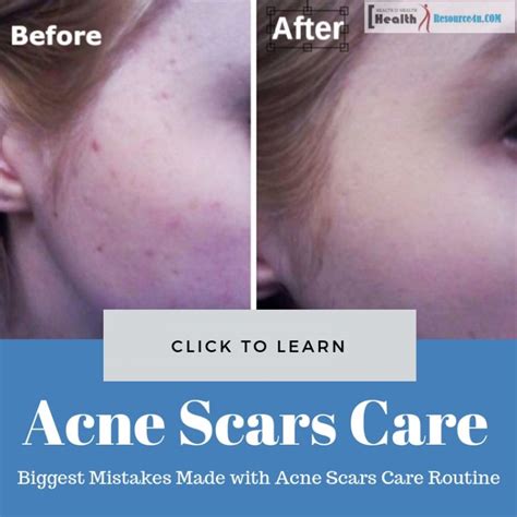 12 Biggest Mistakes Made With Acne Scars Care Routine