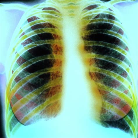 Chest X Ray Of Lungs With Cystic Fibrosis Photograph By Simon Fraser