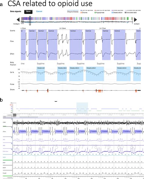 Polysomnography In Central Sleep Apnea A The Above Tracing Shows