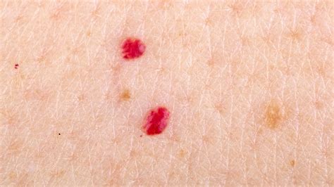 The Difference Between Skin Tags And A Cherry Angioma