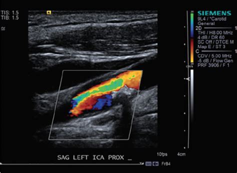 Asymptomatic Carotid Artery Stenosis Practical Neurology