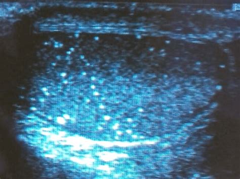 Ultrasonography Examination Revealed Microcalcifications In Large