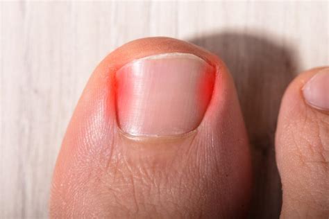 When An Ingrown Toenail Requires Help From Your Podiatrist Optima Foot