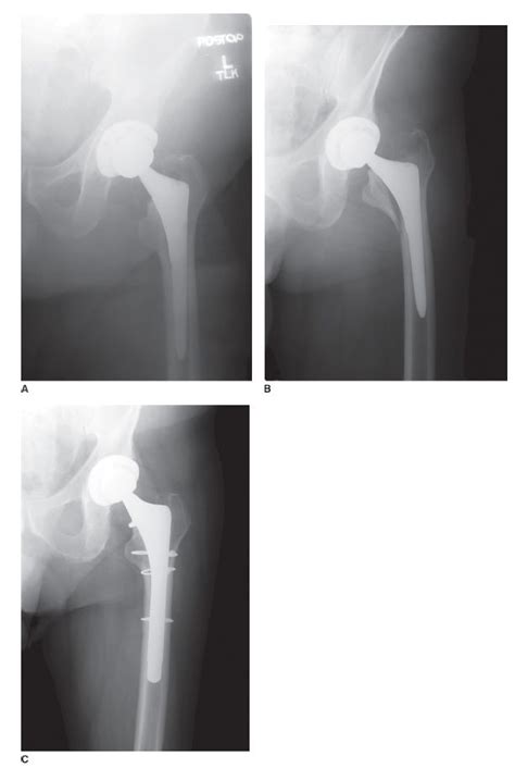 Postoperative Periprosthetic Femur Fracture Around Total Hip