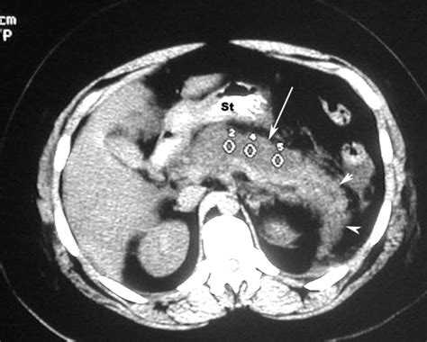 Pancreas Pancreas On Ct Scan