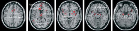 Sexual Function In Men And Women With Neurological Disorders The Lancet