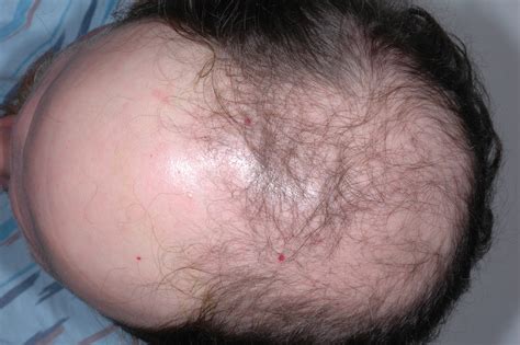 Alopecia Androgenetic Pulmonology Advisor