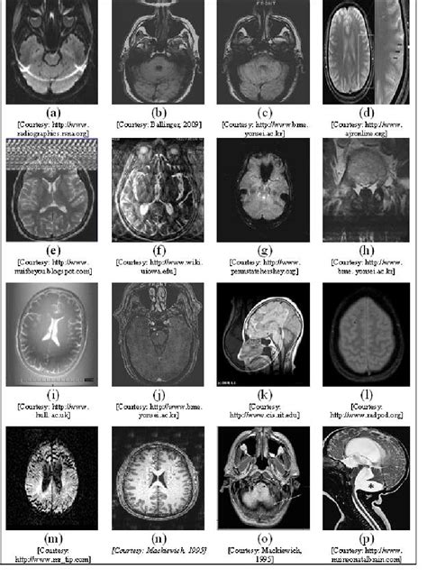 Different Types Of Artifacts In Brain Mri A Chemical Shift B