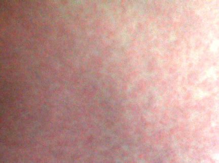 Zika virus rash is spread by the aedes genus of mosquitoes found not only in africa but the pacific islands, the americas, and southern asia. Zika Virus Rash - Pictures, Symptoms, Causes, Treatment ...