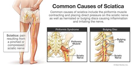 Sciatica Spine Surgeon In The Woodlands Tx Houston Advanced Spine Thomas J Cartwright Md