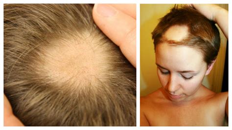 Alopecia Areata Cura Definitiva