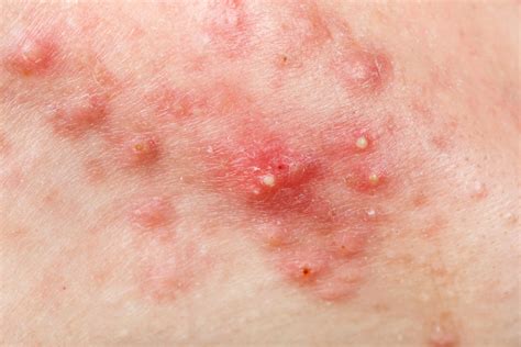Symptoms Causes And Treatment Of Nodular Acne By A Dermat Mfine