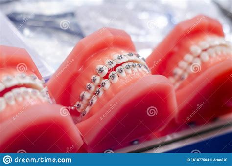Demonstration Teeth Model Of Orthodontic Bracket Or Brace Stock Photo