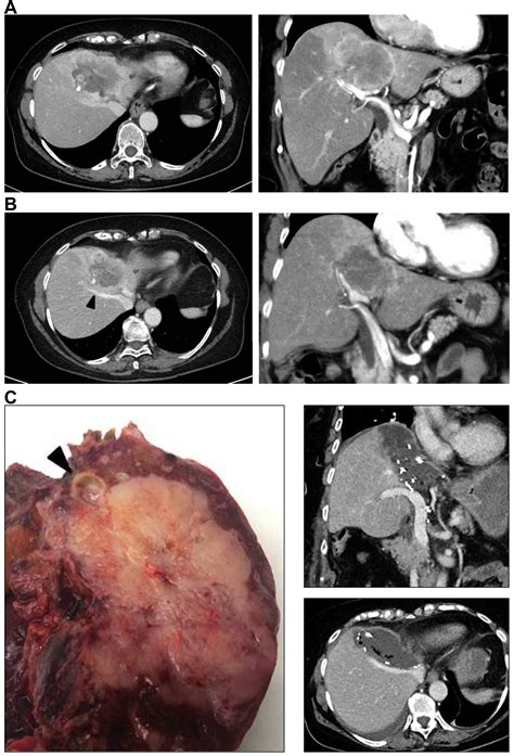 Liver Resection And Transplantation For Intrahepatic Cholangiocarcinoma