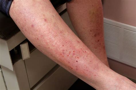 Dermatitis Herpetiformis Treatment Options Celiac Rash Savehealth