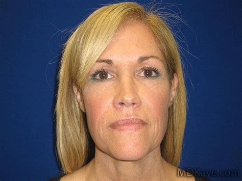 Hopkinsville Ky Face Lift Rhytidectomy Before And After Photos