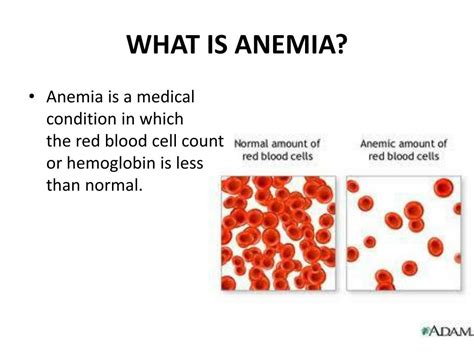 Ppt Anemia Powerpoint Presentation Free Download Id2866227