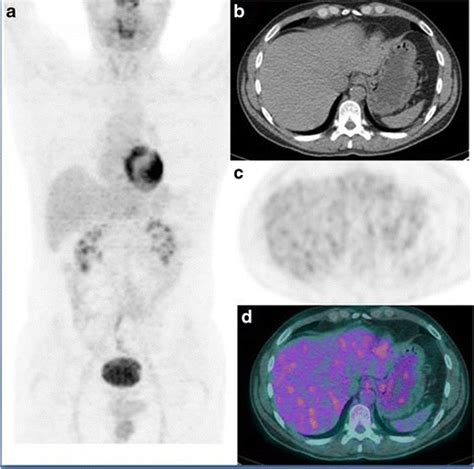 Petct Images Of One Patient With Gastric Malt Lymphoma Not Fdg Avid A