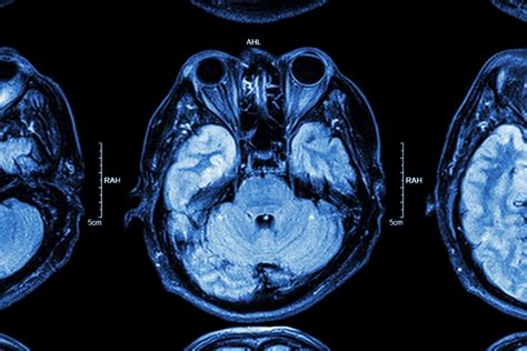 Distinguishing Temporal Lobe Epilepsy With Mesial Temporal Sclerosis