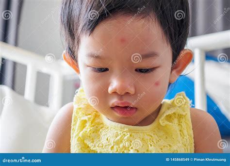 Cute Little Asian Girl With Allergy Red Spot Face Stock Image Image