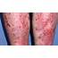 Eczema Treatment Skin Disease  YouTube