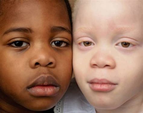 Twins With Different Skin Colors 15 Pics