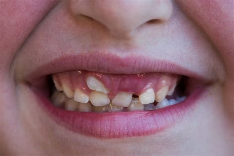How Common Is It For Adults To Still Have Baby Teeth Britt Caron