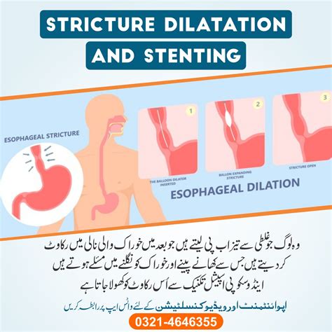 Stricture Dilation And Stentning Drmasifgul