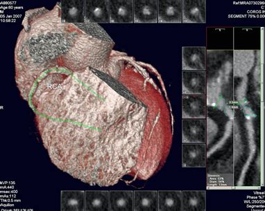 Coronary Computerised Tomographic Angiogram Coronary CTA Peter Yan