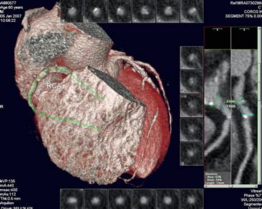 Coronary Computerised Tomographic Angiogram Coronary Cta Peter Yan