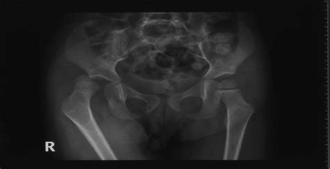 Traumatic Posterior Dislocation Of The Hip In A 3 Year Old C