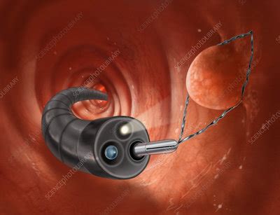 Polyp Removal During Colonoscopy Stock Image C Science
