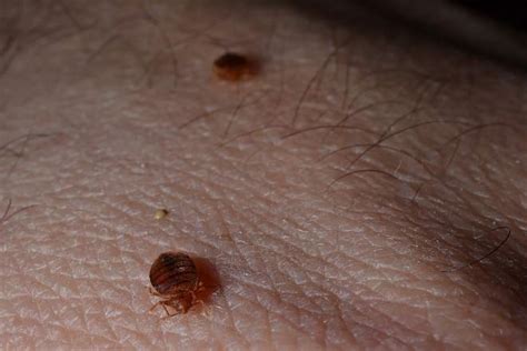 Bug Under Skin