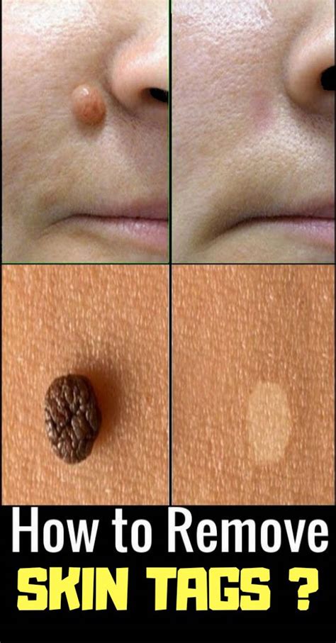 Quick Easy Cheap Home Remedy To Get Rid Of Skin Tags Skin Tag Skin