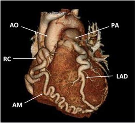 Cta 3d Reconstruction Of The Heart Aorta Ao Right C Open I