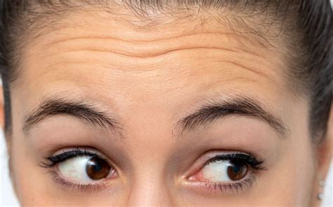 How To Banish Forehead Lines Naturally Clear Skin Regime