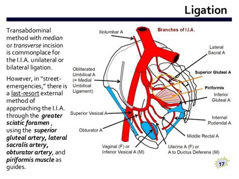 The common iliac arteries arise on the front of the body of the fourth lumbar vertebra to the left of the medial plane, and, diverging from each other, proceed downward and laterally on the spinal column. External Ligation of Internal Iliac Artery (E.L.I.I.A ...