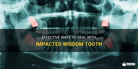 Effective Ways To Deal With Impacted Wisdom Tooth Medshun
