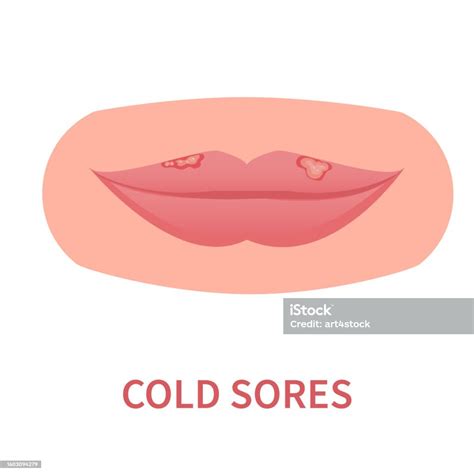 Cold Sores Outbreak Of Herpes Hsv On Lips Stock Illustration Download