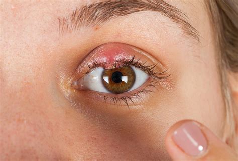 8 Home Remedies To Get Rid Of Eye Stye Emedihealth